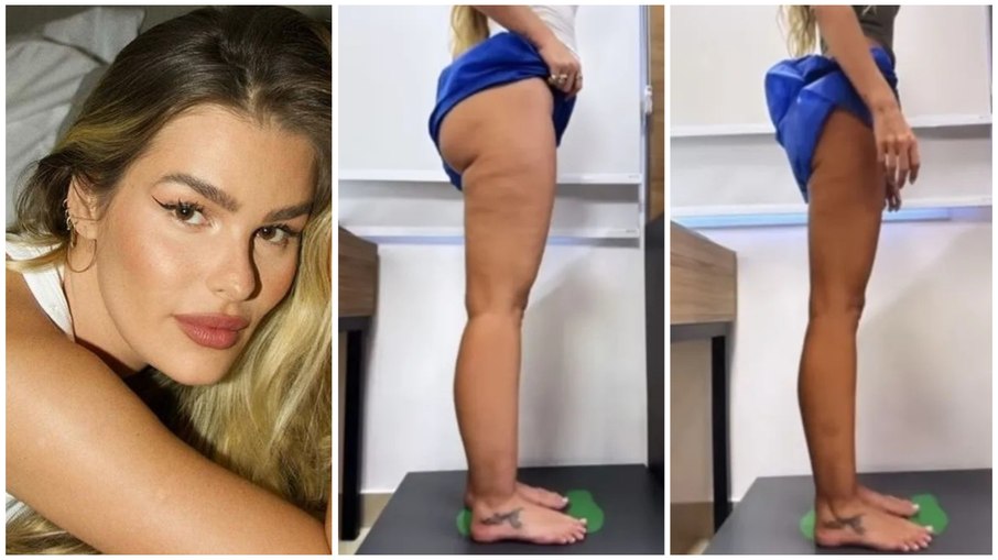 Transformação Radical: Yasmin Brunet revela como venceu o lipedema e perdeu 25kg